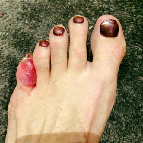 foot problems with pictures|pictures of sores between toes.